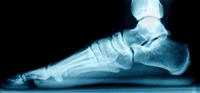How Flat Feet Can Lead to Posterior Tibialis Tendonitis