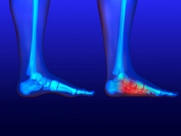 Causes and Symptoms of Flat Feet