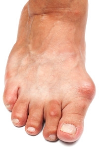 Possible Reasons Why Bunions May Develop