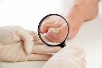 Possible Ways to Prevent Toenail Fungus