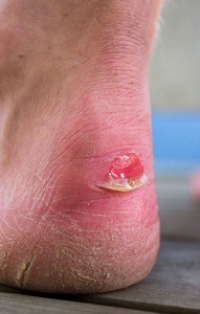 Blisters on Feet: What you Need To Know